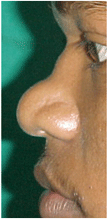 nose reshaping in punjab